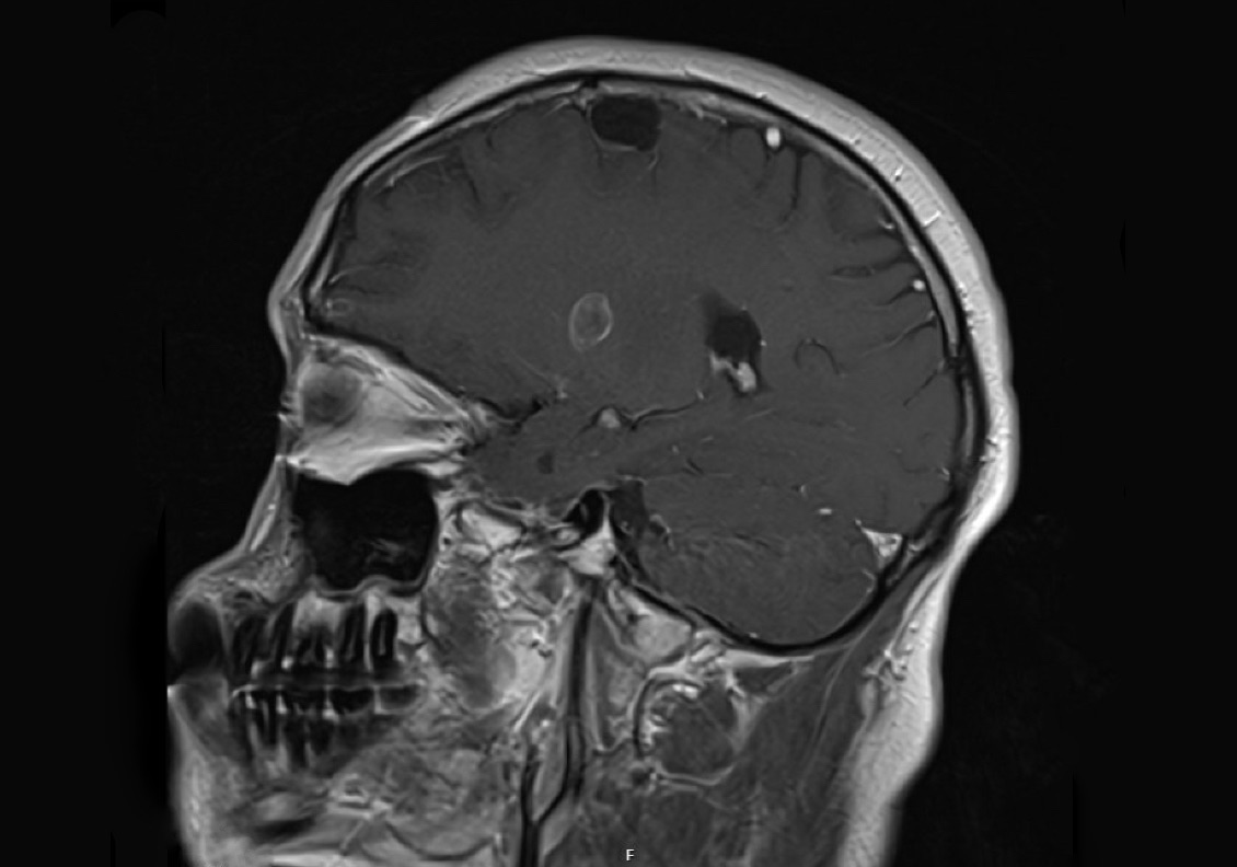 Brain CT scan showing multiple lesions - sagittal view