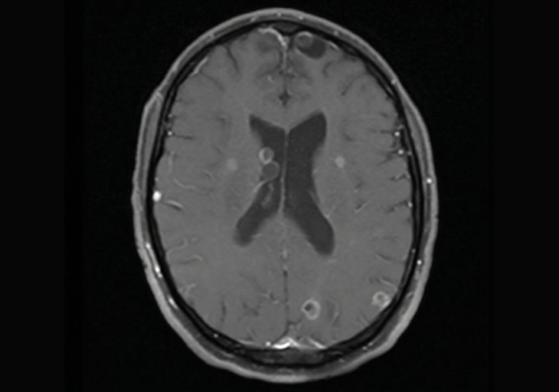 Brain MRI showing characteristic ring and dot lesions