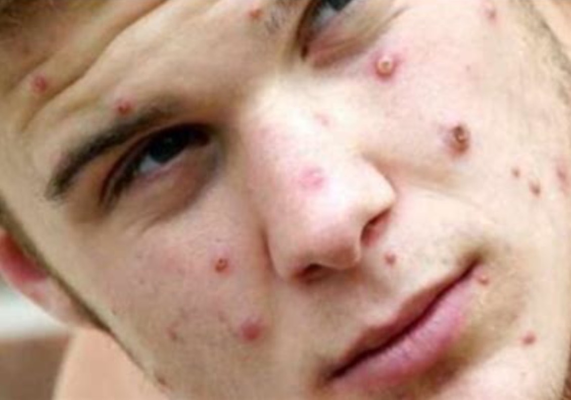 Monkeypox virus