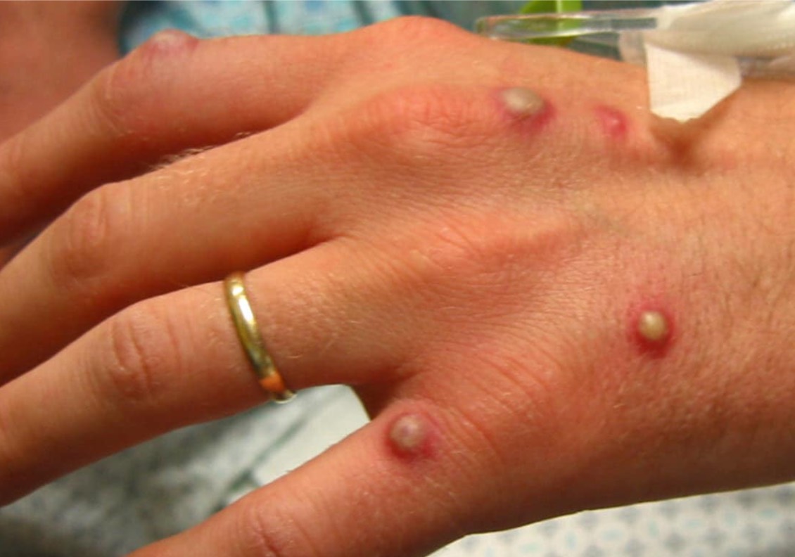 Pustules on hand