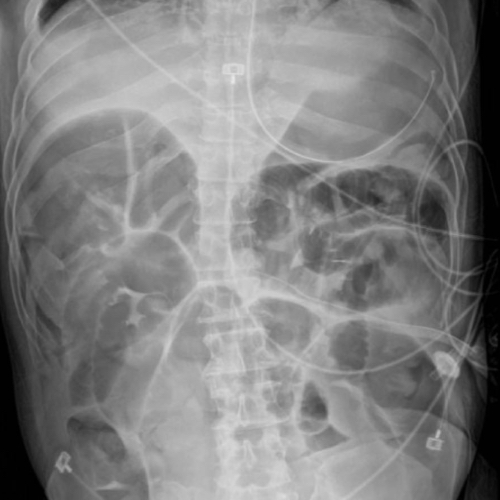 Intestinal Obstruction