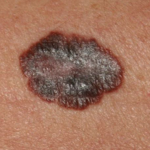 Skin Cancer: What Farmers Should Know