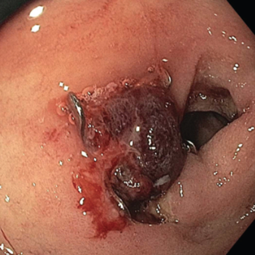 Upper GI Bleeding